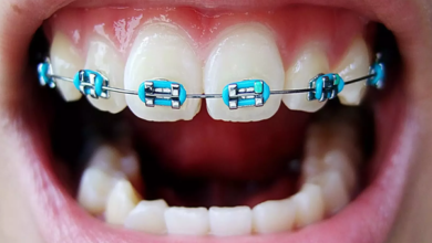 چرا بعد از برداشتن بریس ارتودنسی حس میکنم دندان هایم لق شده اند؟