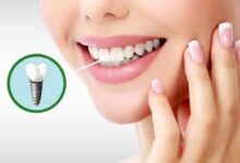 نکات مهم در مورد درد پس از جراحی ایمپلنت دندان