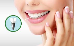 نکات مهم در مورد درد پس از جراحی ایمپلنت دندان